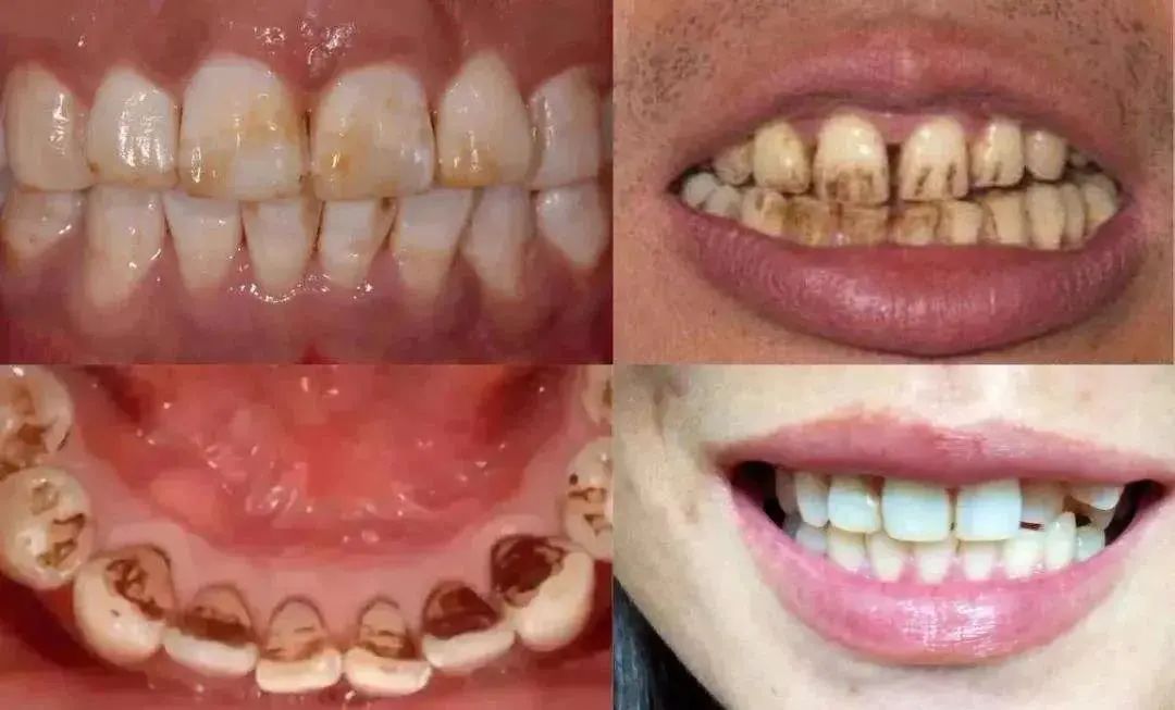各种食物残渣覆盖在牙齿上,让牙齿发黄发黑还会伴随着一股难闻的恶