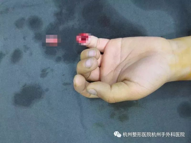 萧山6岁男孩上课时突然手指断了!