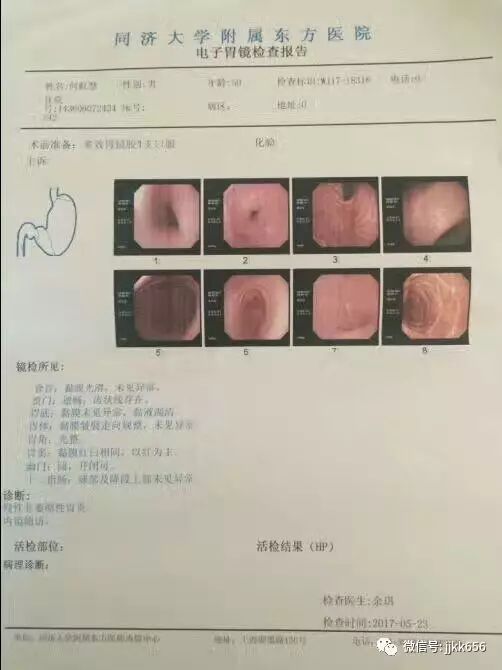 浙江反流性食管炎患者何先生采用"降逆安胃细胞疗法"治疗3疗程后,检查