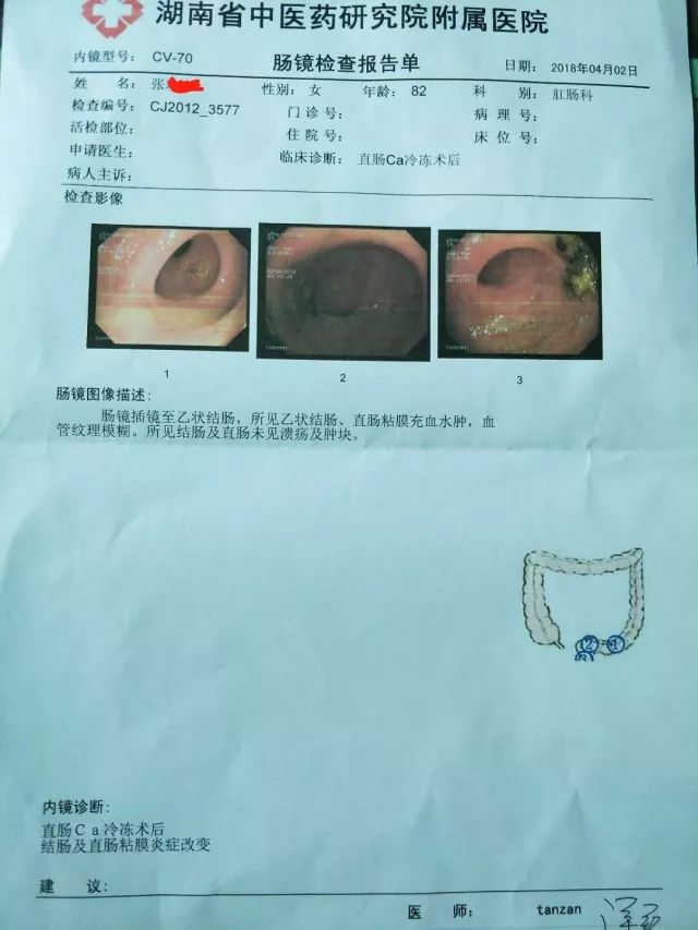 【病例】2例低位直肠癌患者冷冻治疗后肠道恢复非常好