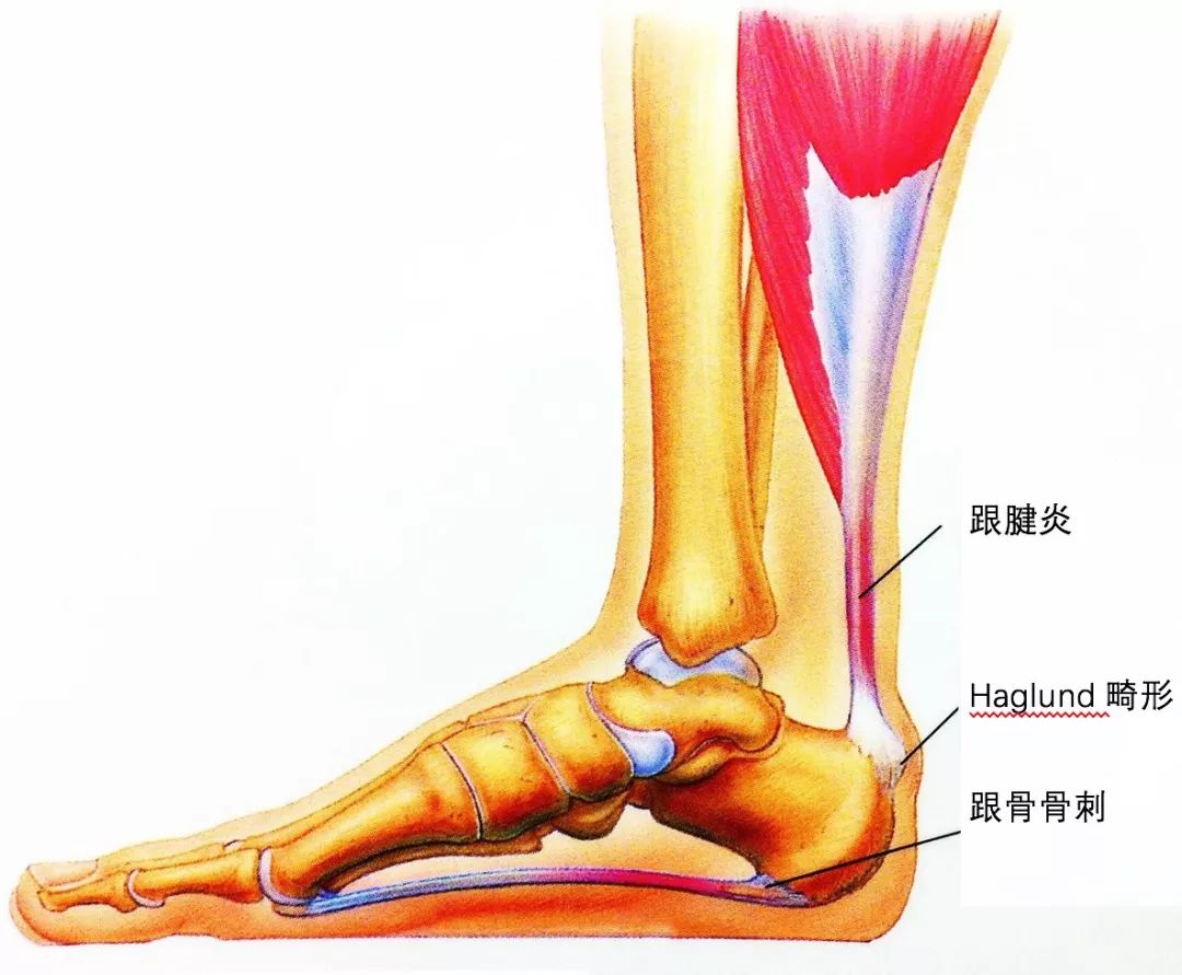 发生部位在跟腱的跟骨止点附近,很多被当做"跟腱炎"错误治疗; 6