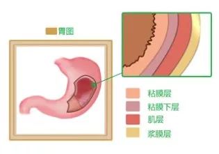 健康头条  常见病   胃是位于消化道中间一个膨起的组织,包括贲门,胃