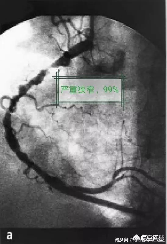 心脏造影有叫冠脉造影,目前仍是诊断冠心病的金标准,但不是谁心里难受