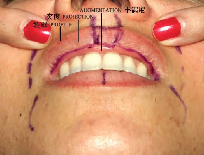 "非接触式"注射丰唇技术分享:不损伤唇黏膜(含视频)