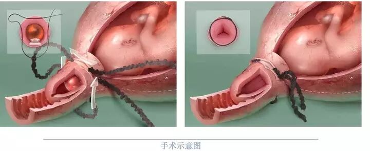 准妈妈们注意了!怀孕熬过前3个月后还要当心这种病