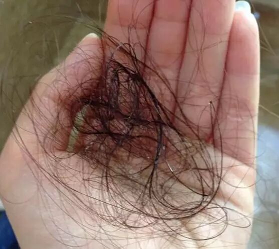 14岁姑娘成了葛优！秋季脱发千万要注意，这是身体器官发出的信号！