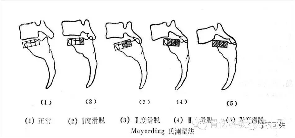 腰椎滑脱的临床表现及诊断