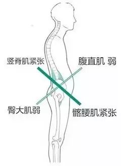 圆肩驼背,不是那么简单!