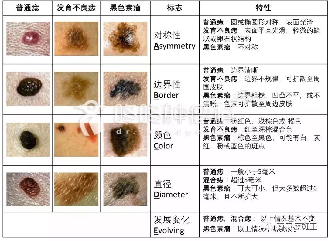 普通痣发育不良痣黑色素瘤都是什么样子呢