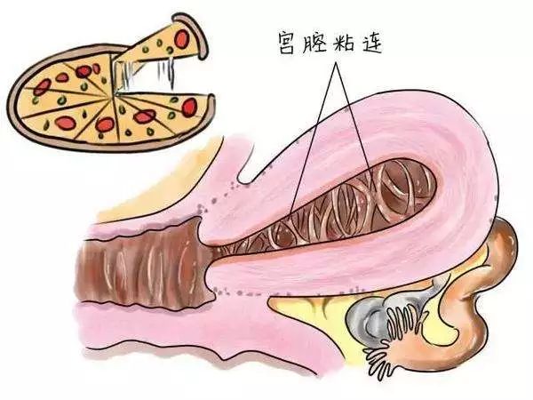 反复流产?小心宫腔粘连会不孕!抚州华山医院