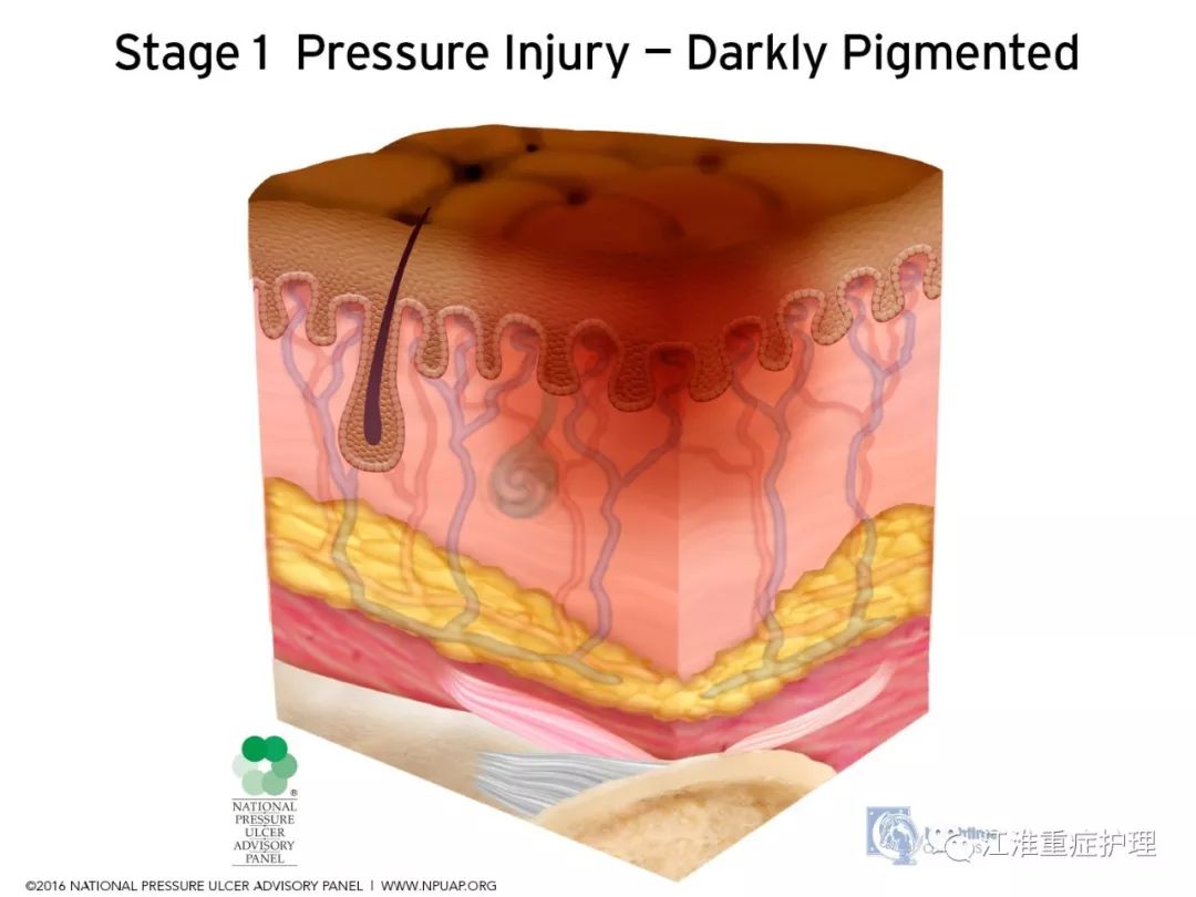 [图文]npuap2016版压力性损伤定义与分期