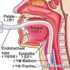为什么购买可视硬性喉镜麻醉医生的“得力助手”——可视喉镜_https://www.jmylbn.com_新闻资讯_第9张