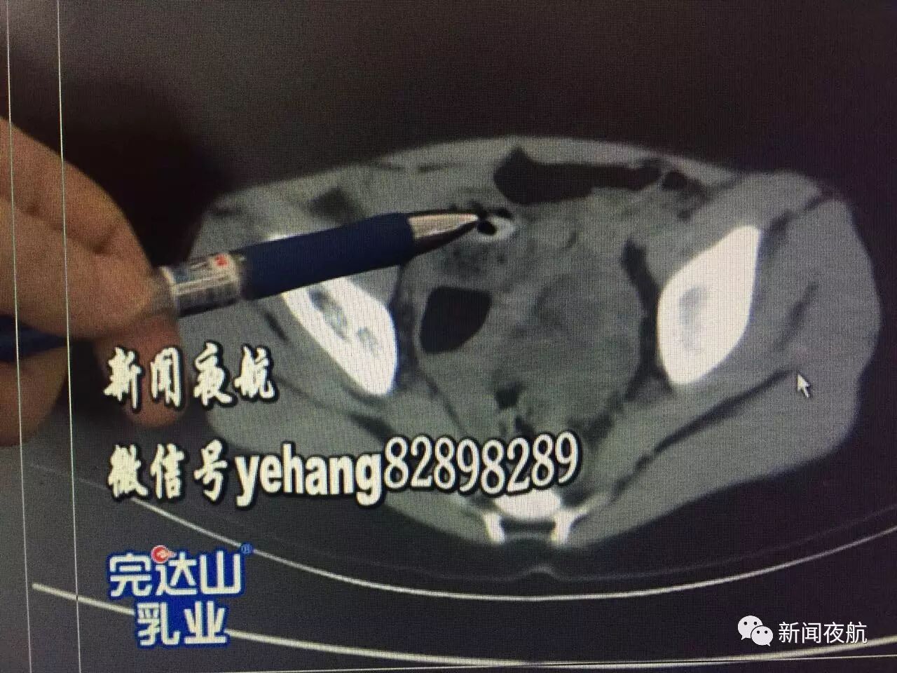 黑龙江3岁女孩囫囵吞枣 枣核尖儿刺入肠壁