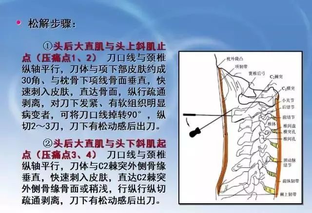 针刀松解术治疗颈椎病操作规范