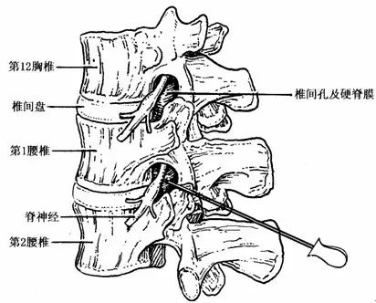 蛣2后外侧观腰椎椎间孔外孔针刀松解术