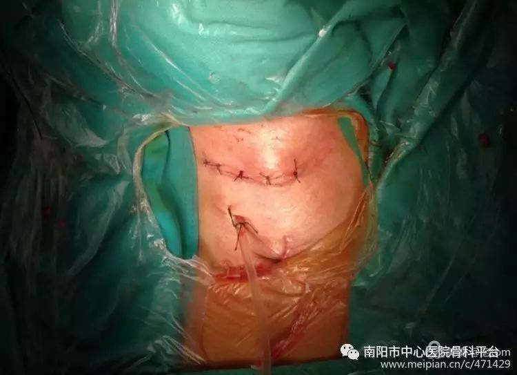 >典型病例:一例陈旧性颈椎单侧关节突交锁脱位的手术治疗   进行前路