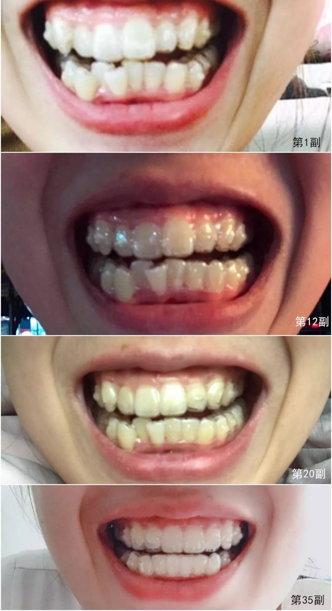 都莱美 无托槽隐形牙齿矫正器套装，内含1#、2#、3#、4#、5#