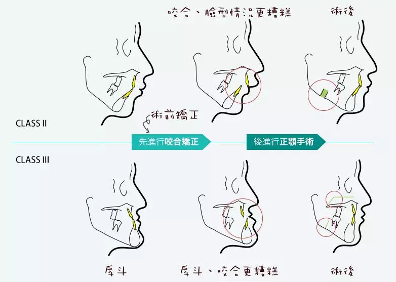 主要分为三个过程: 1,术前正畸 2,正颌手术 3,术后正畸 一般严重骨骼