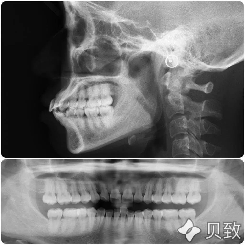 附上一张ct图 拍了x光片,我是骨性嘴突,在和医生沟