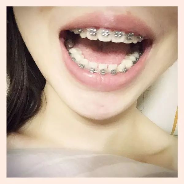 (上托槽第一天拍的)
