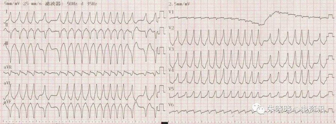 识别致命的心电图
