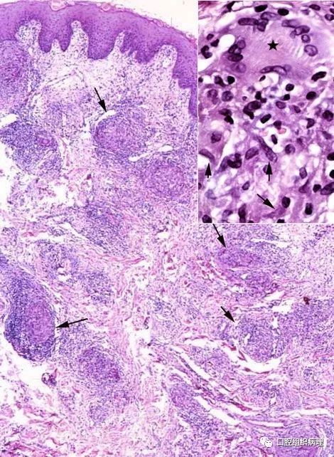 肉芽肿性唇炎 上皮下结缔组织中及血管周围见上皮样细胞,淋巴细胞及