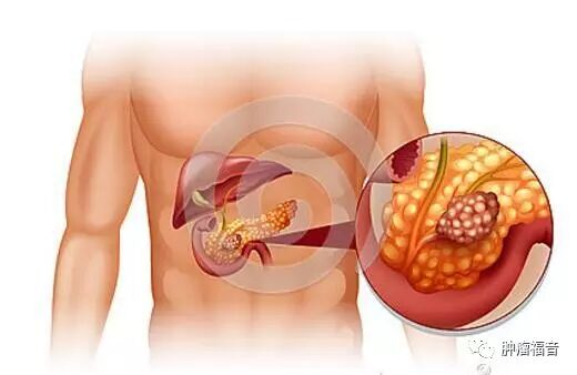 胰腺癌晚期能活多长时间