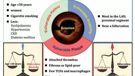 欧洲心脏杂志刊登于波团队文章:STEMI患者中25%为斑块侵蚀,年轻女性和吸烟者发生率高