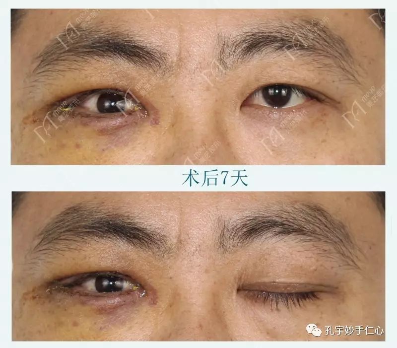 右眼(义眼)上睑下垂,下睑退缩术后2月案例!