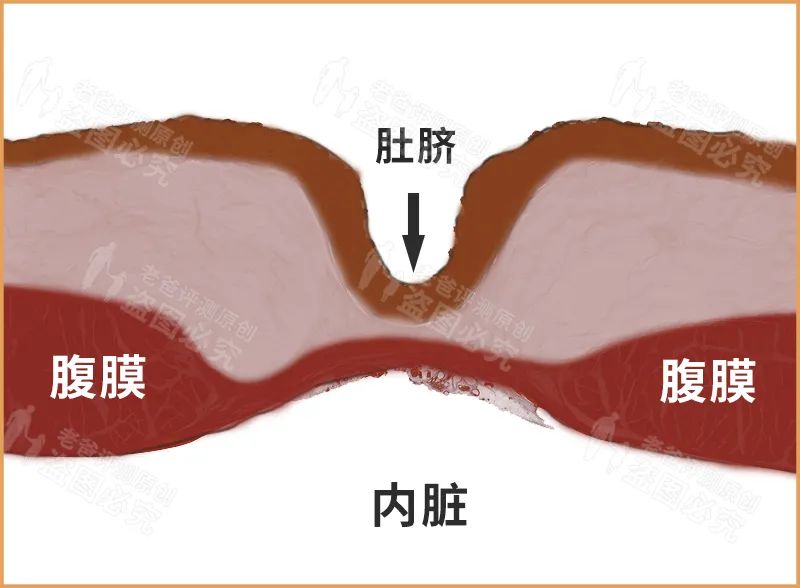 肚脐眼真的连着肠子吗