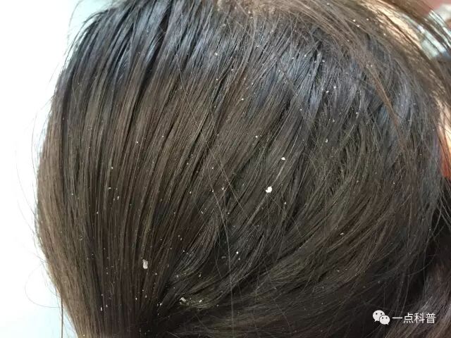 #医生必开的药#头皮脂溢性皮炎，你一定用过这几个药，但是效果如何呢？