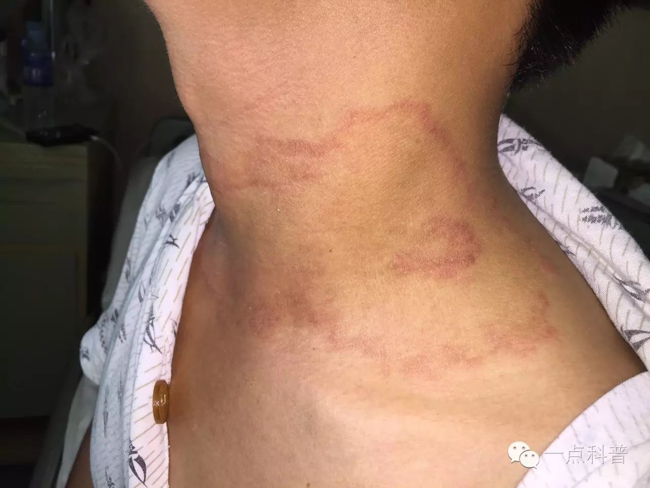 体癣的早期症状图片_体癣图片_体癣初期图片