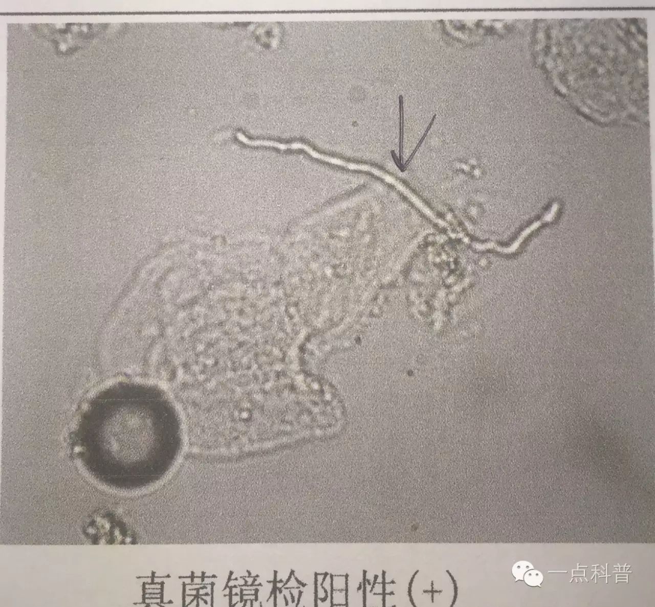 体癣初期图片_体癣的早期症状图片_体癣图片