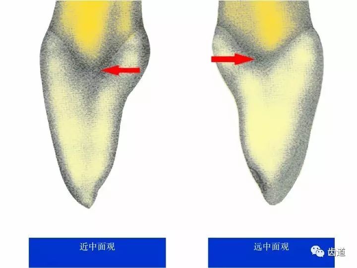 四)近远中牙颈线高度的对比 近中牙颈线高 远中牙颈线低