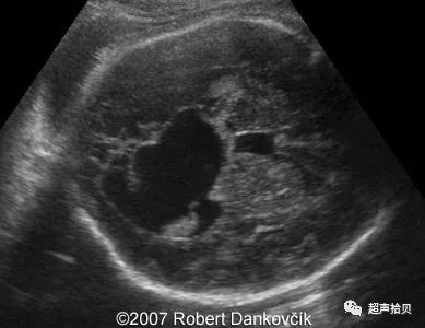 胎儿及小儿蛛网膜囊肿-江苏省超声医学工程学会