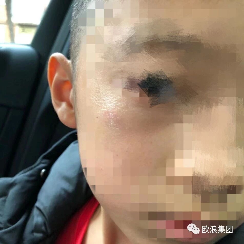【欧浪网】 华人小孩在校被暴打 单亲妈妈坚强为孩子维权！