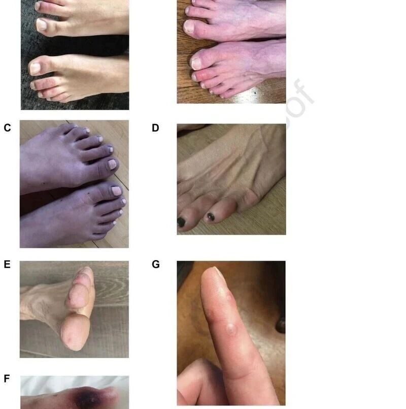 【欧浪网】注意！新冠病毒可让人出现皮肤病变 一旦发现立刻检测