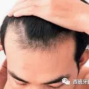 【欧浪网】 西国男性秃头比例全球第二 中国秃头男性最少