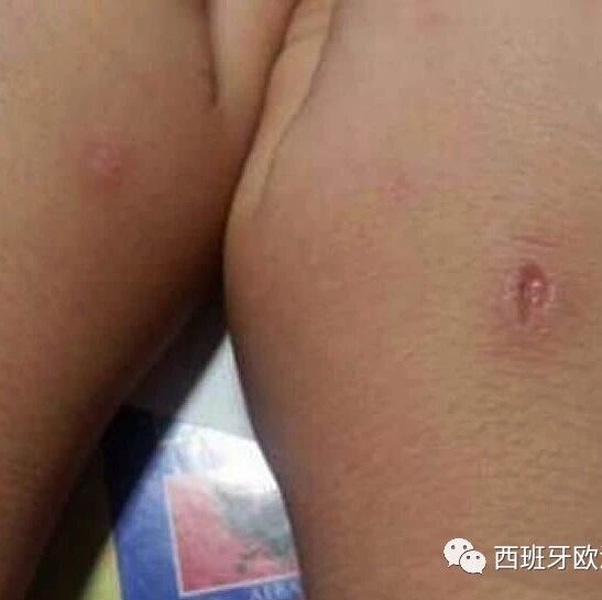 【欧浪网】你听过“魔鬼痕迹”吗？ 一股诱导自残的风气进入学校！