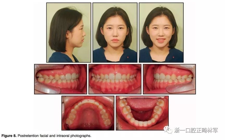 文献优秀正畸病例赏析--上颌垂直向发育过度,骨性ii类高角病人的治疗