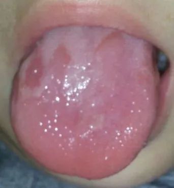 儿童的舌头容易出现的三种问题，哪一种需要手术治疗?