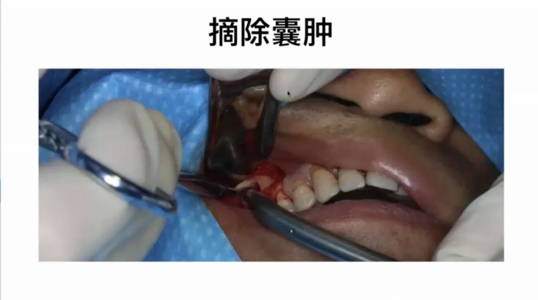 研讨会|北京大学口腔医学博士黄志威:上颌窦外提升同期囊肿摘除一例