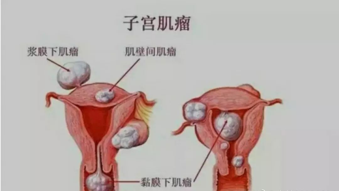 二,按子宫肌瘤与子宫肌壁的关系分类宫体子宫肌瘤合并宫颈子宫肌瘤:1.