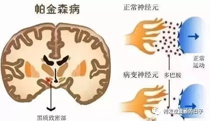 在危害我国中老年的致残性疾病中,帕金森病排名第三,并出现了不断