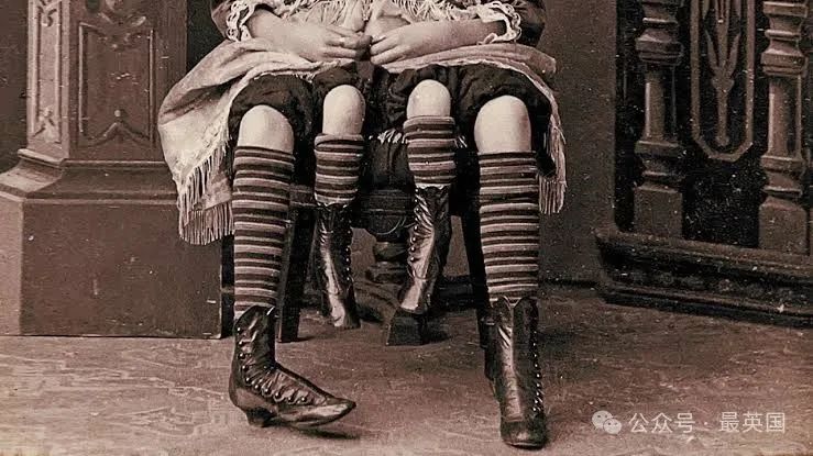 Acolhida pelo circo e alvo de espetáculos: Myrtle Corbin, a mulher de  quatro pernas