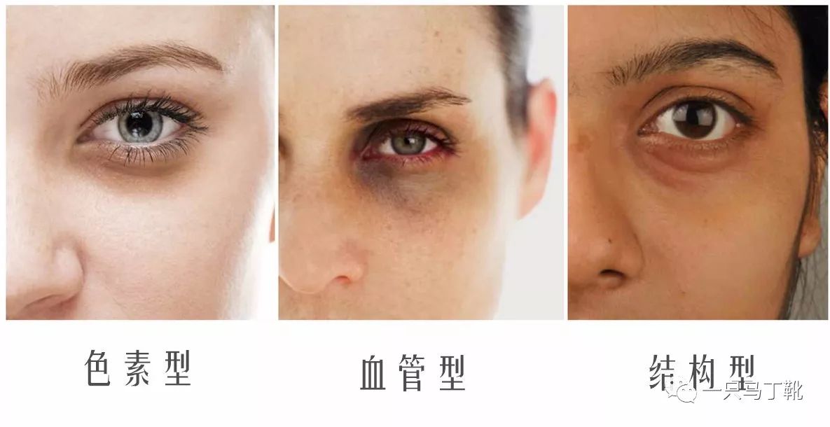 色素型一般呈咖啡色等深色,一般都是熬夜,卸妆不彻底,色素沉积导致的.