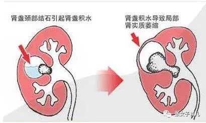 如果你怀孕了,不注意这些事情,孕期肾积水会让你疼得死去活来!