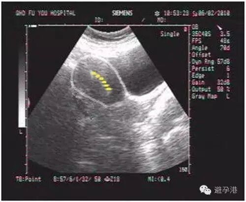 吉妮致美环怎么样吉妮致美节育器超声图像解读_https://www.jmylbn.com_新闻资讯_第3张
