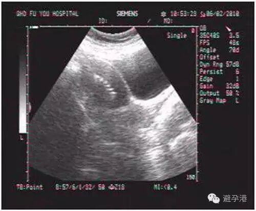 吉妮致美环怎么样吉妮致美节育器超声图像解读_https://www.jmylbn.com_新闻资讯_第2张