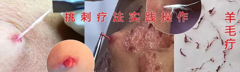 挑羊毛疔疗法又名"挑刺疗法","截根疗法",是现代中医的一种特效疗法